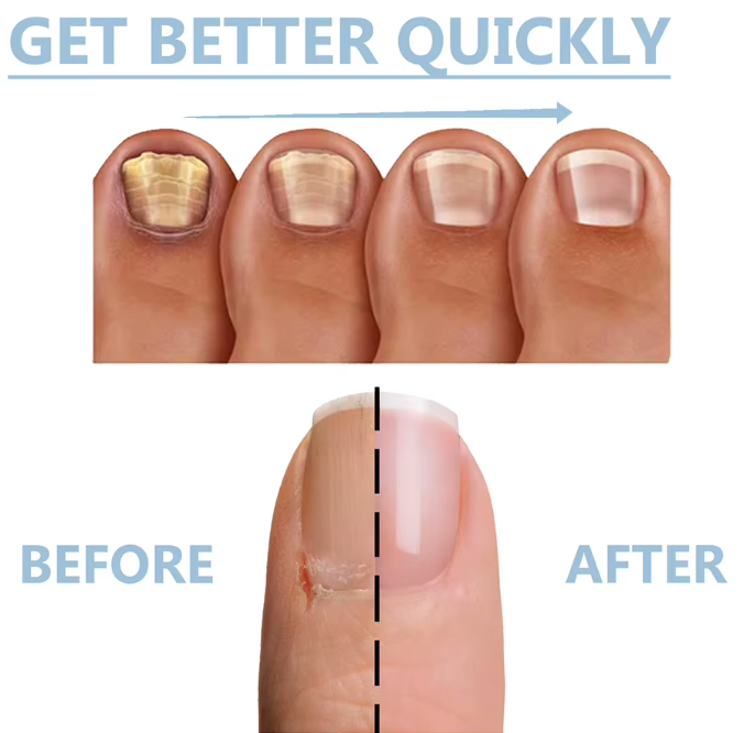 Nail Guard™ - Von beschädigt und brüchig zu stark und schön